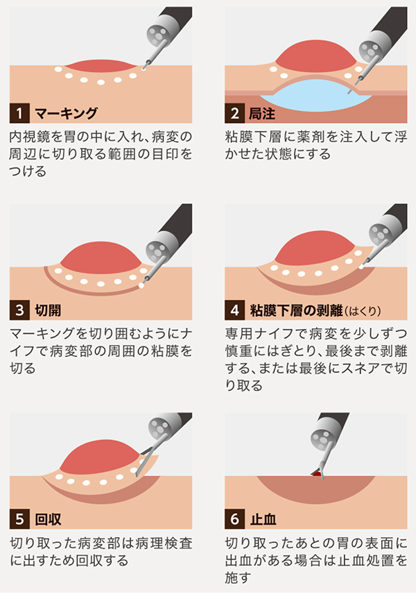 内視鏡的粘膜下層剥離術（ESD）とは