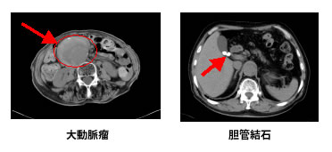 腹部CT