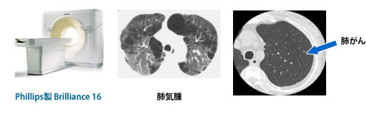 胸部CT検査