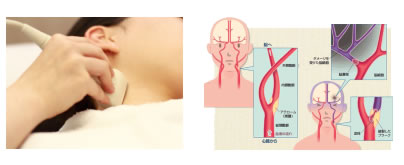 頸動脈エコー
