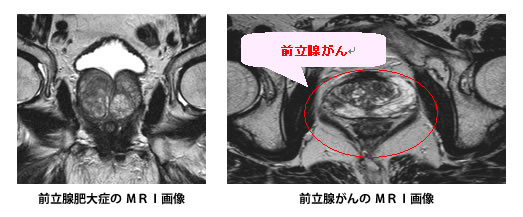 前立腺がんMRI検査